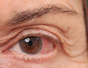 Comment soigner une conjonctivite ?